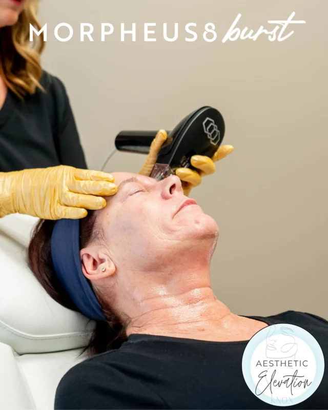 Introducing #Morpheus8Burst, the latest in fractional radiofrequency technology designed for skin tightening and contouring. With its unique Burst and Scale functionalities, it delivers precise and noticable results by stimulating collagen and shaping areas of the face and neck to restore definition and support!

Experience the difference! Book with Us!

#AestheticElevationKnoxville #KnoxvilleTN #PowellTN #KarnsTN #MWMInMode #NonSurgicalFacelift #RFSkinTightening #FacialContouring #FacialRejuvenation