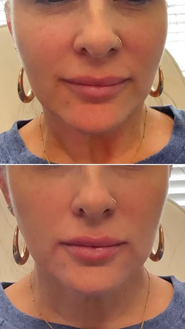💎 Everyone talks glow… but few know balance.
The real secret? It’s not just tox. Not just filler. Not just a facial.
It’s how they work together — skin, structure, and subtlety in perfect sync… that’s Aesthetic Elevation. 
Tox smooths. Filler defines. Our clinical facials refine. 
And don’t forget the CHIN 👀 — where quiet confidence begins.
✨ The secret’s in the symmetry. Comment or send us a DM for more info about our ShapeUp Consultations! 
#AestheticElevationKnox #RegenerativeAesthetics #BalancedBeauty #LuxuryRedefined #FacialFillerTox #knoxvillefiller #rhaknox #defynefillerknox #restylaneKysse #lipfillerknoxville #chinfiller 
📍#aestheticelevationknox
📧 info@aestheticelevationknox.com
💻 aestheticelevation.com 
📆 https://dashboard.boulevard.io/booking/businesses/7b4f475a-8309-4e2e-bf3f-67d315011e8f/widget#/visit-type
☎️ (865) 313-3409 Call or Text